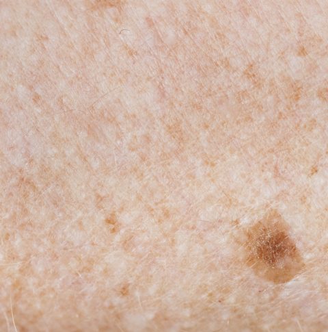 Closeup of freckled skin