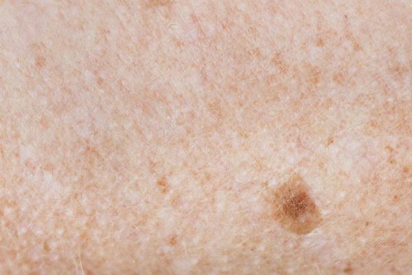 Closeup of freckled skin Closeup of freckled skin
